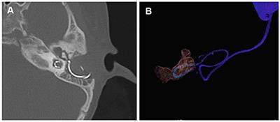 Application of Multiplanar Volume Reconstruction Technique for the Assessment of Electrode Location and Analysis of the Correlation to Cochlear Programming and Performance in Common Cavity Deformity